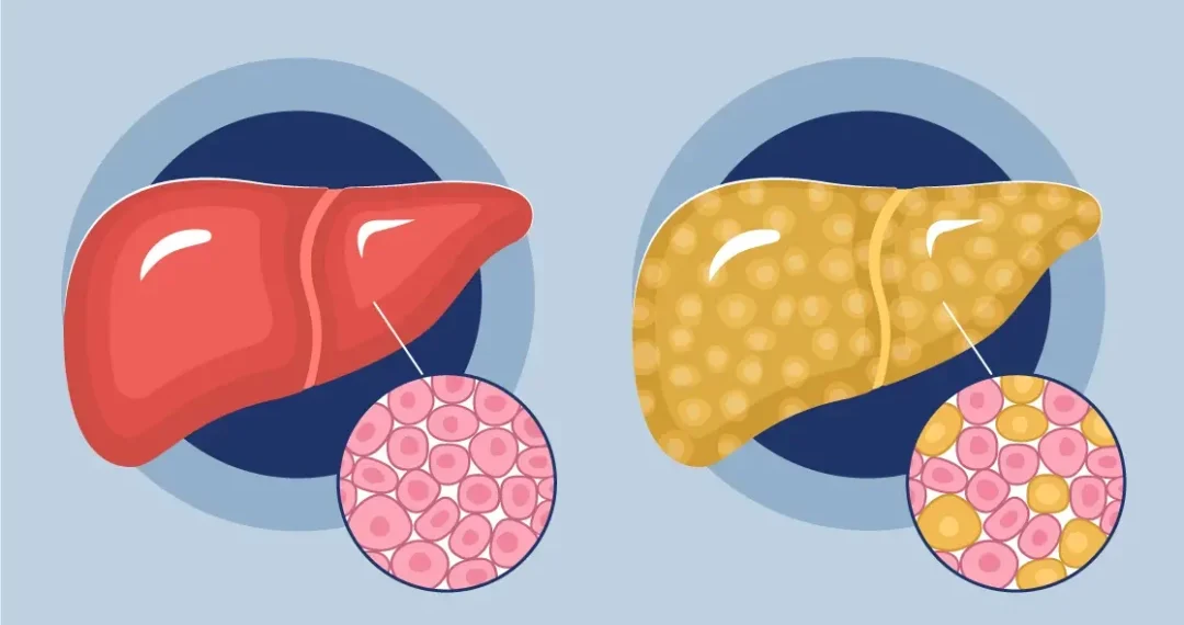 Hígado graso y harinas blancas: cuál es el impacto y por qué hay que evitarlas